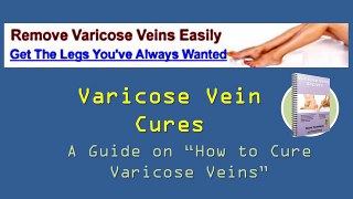 Varicose Vein Cures Can Be Achieved By Using This Diane Thompson Method