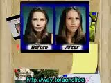Acne Free in 3 Days Get rid of Acne & Pimples Fast