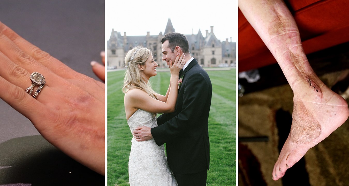 Boston Bombing: A Wedding and a Recovery