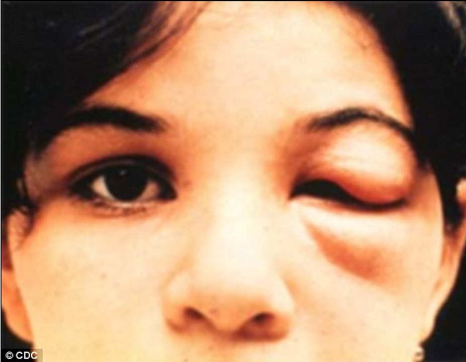 CHAGAS: ILLEGAL IMMIGRANTS HAVE BROUGHT ANOTHER DISEASE TO AMERICA.