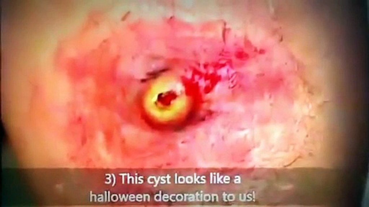 Do Not Buy Ovarian Cyst Miracle by Carol Foster Review Until You See Ovarian Cyst Miracle -- kopia