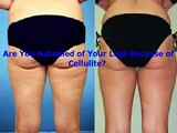 How to Reduce Cellulite on Thighs and Buttocks With Truth About Cellulite