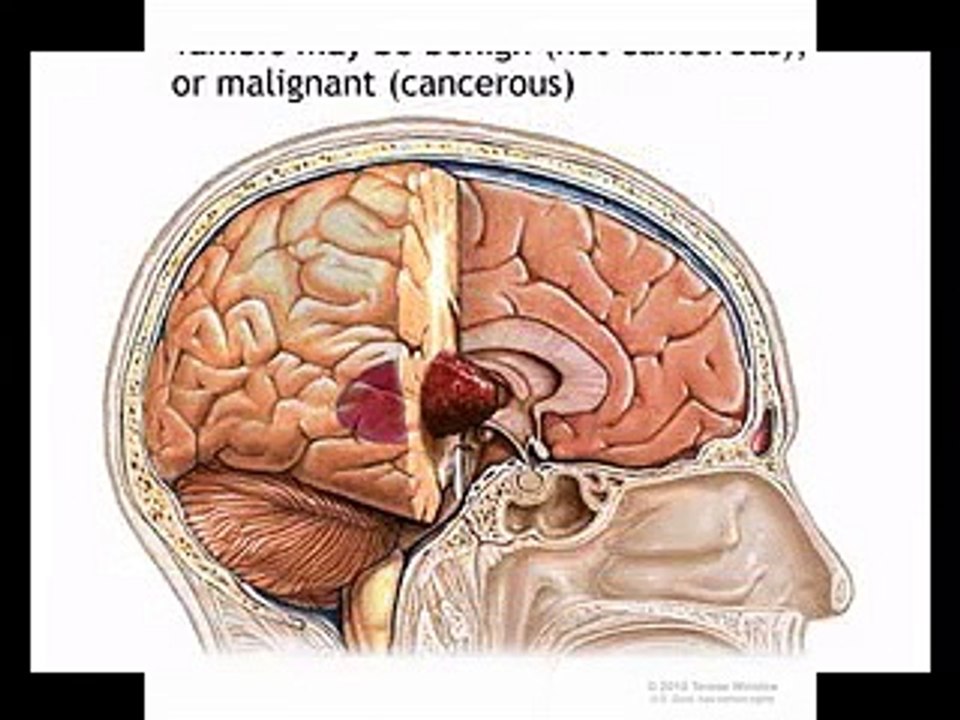 Ung thư não - Triệu chứng và dấu hiệu