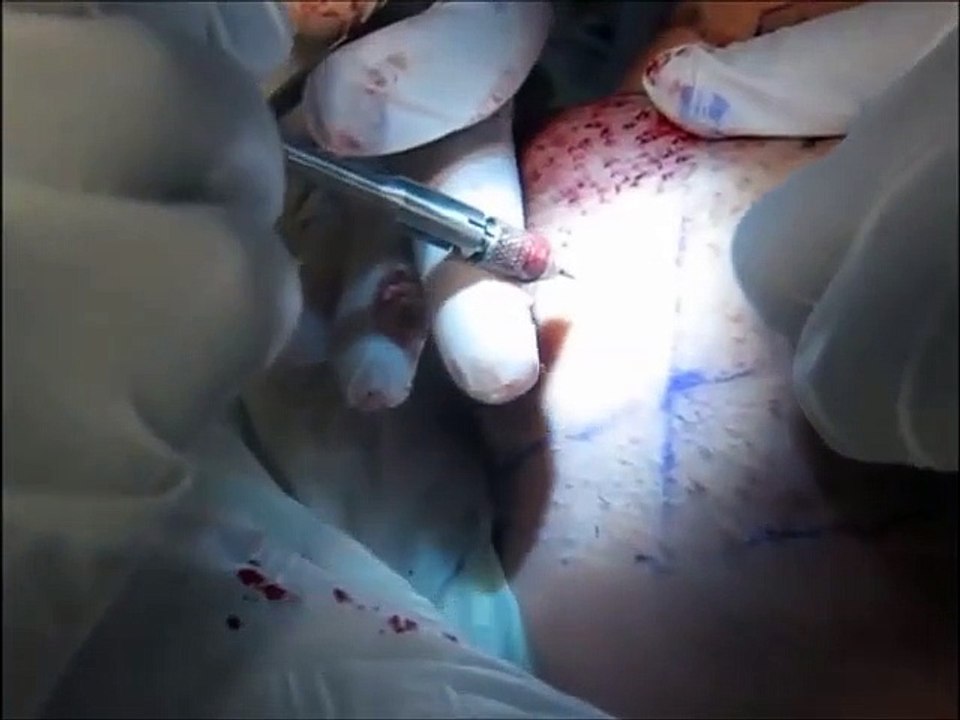 MyWHTC Clinic of Hair loss for Brussels Belgium live surgery patient view