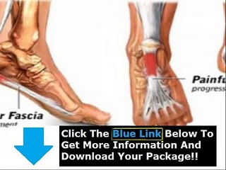 Plantar Fasciitis Treatment Ultrasound + Plantar Fasciitis Cure Time