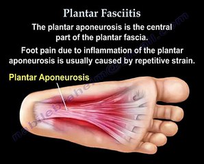 Plantar Fasciitis - Everything You Need To Know - Dr. Nabil Ebraheim