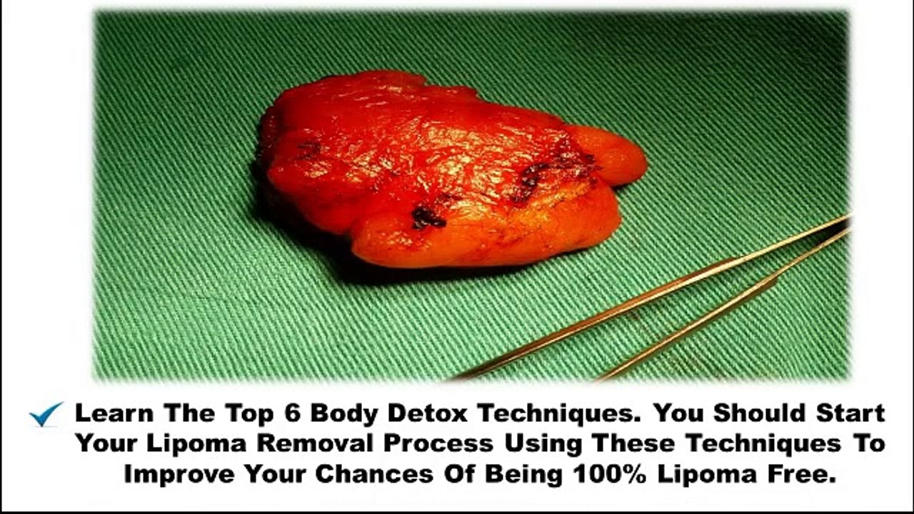 How To Cure Lipoma Naturally