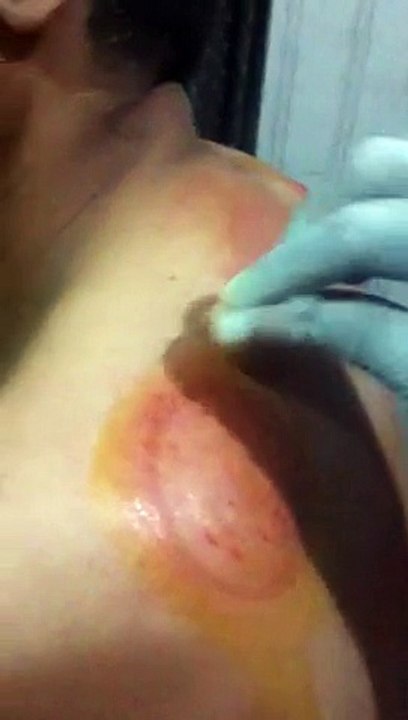 Hijama treatment