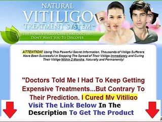 Natural Vitiligo Treatment System Real Review Bonus + Discount