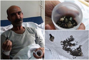 Böbreğinden 794 taş çıktı