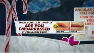 What Is Angular Cheilitis Free Forever