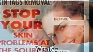 How To Remove Moles Warts And Skin Tags Removal