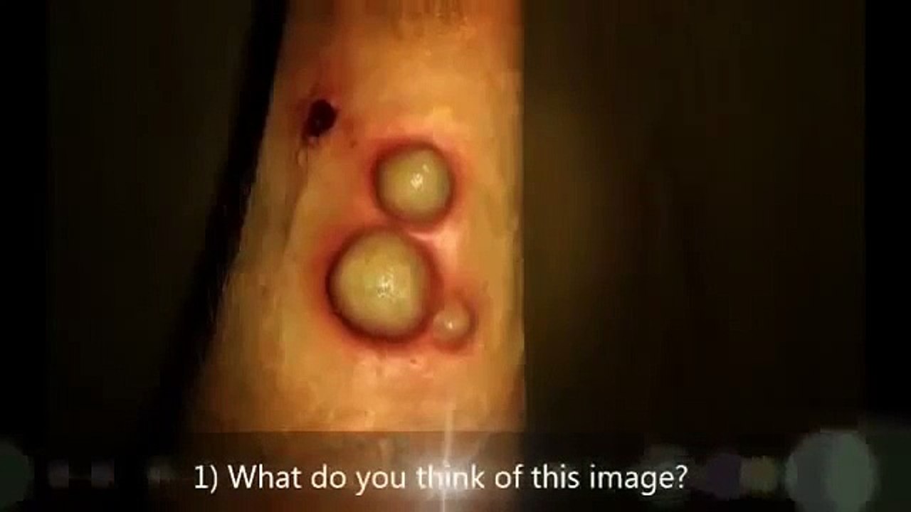 Do Not Buy Ovarian Cyst Miracle by Carol Foster Review Until You See Ovarian Cyst Miracle