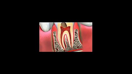 What happens if  you  elect not  to do a  root filling