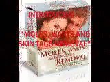 Moles Warts And Skin Tags Removal - How To Safely,Permanently Remove Moles, Warts,Skin Tags