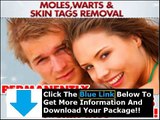 Moles Warts & Skin Tags Removal Review   Best Moles Warts Removal