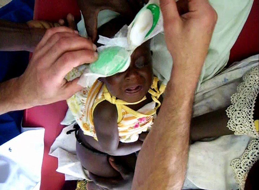 Les Enfants de l'Aïr  - Hawa, 11 mois, opérée à Tanout (Niger) d'une double cataracte congénitale