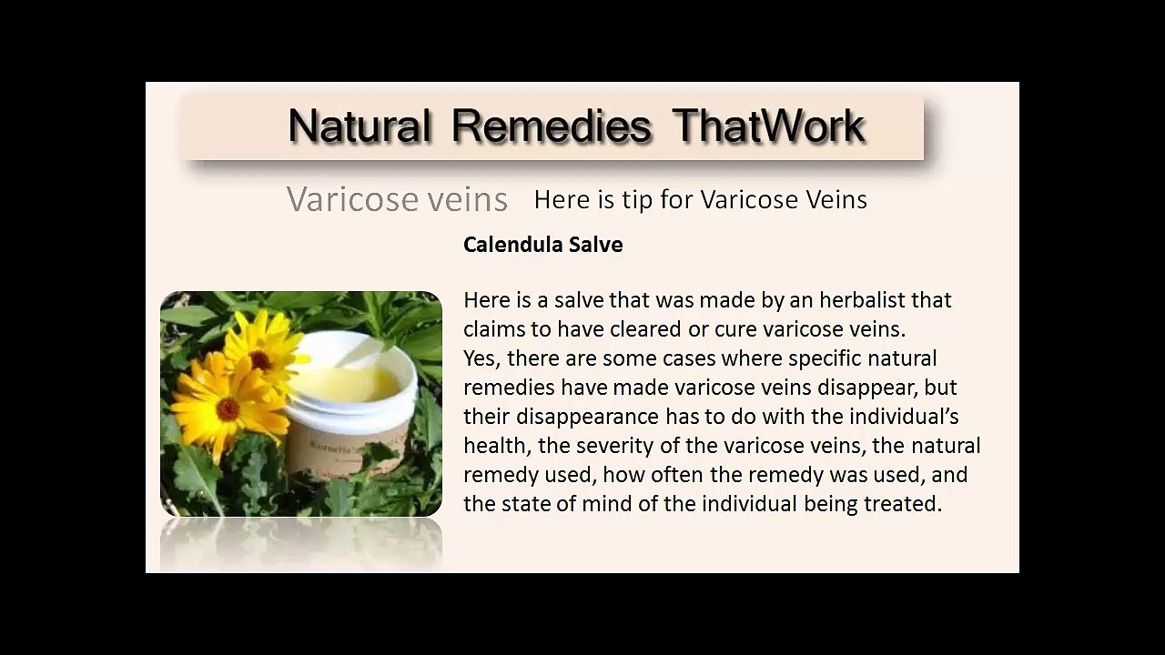 Varicose Veins Treatment Natural using Herbs for Varicose Veins