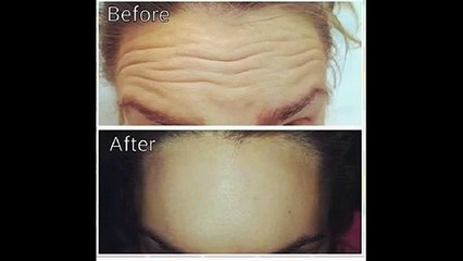 Botox Leeds - www.claesthetics.com