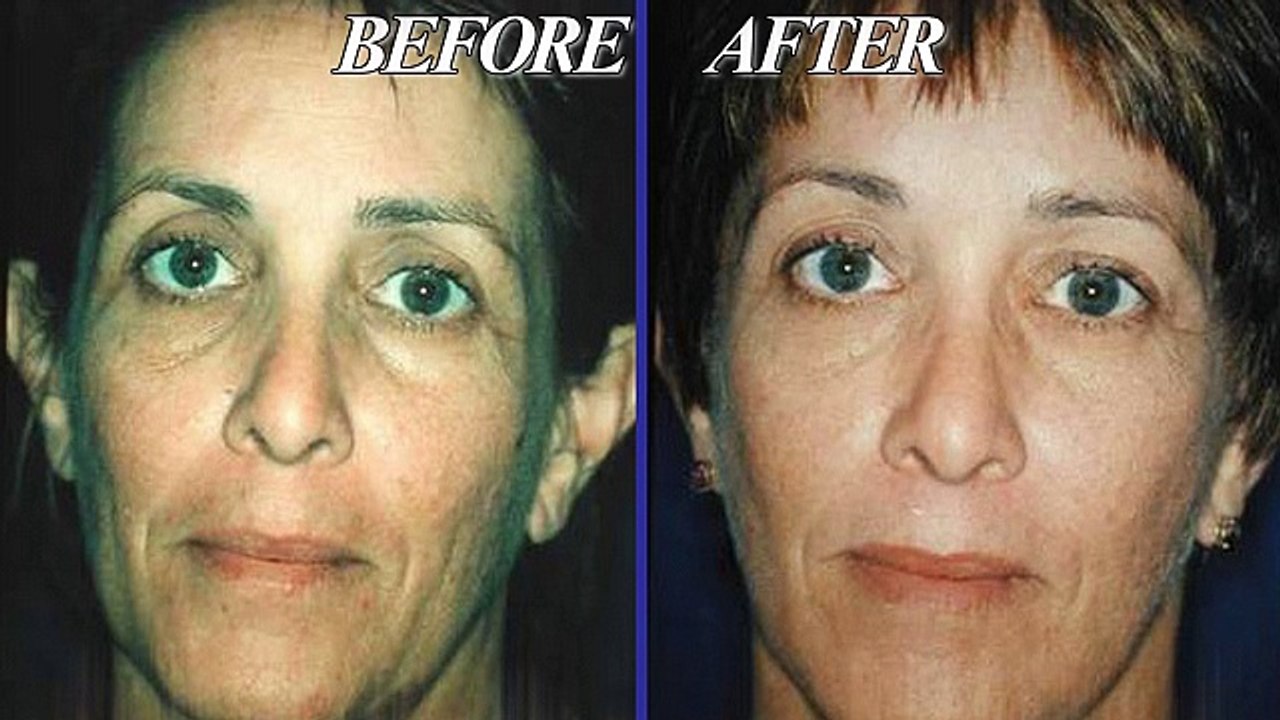 Rhinoplasty Surgery To Improve Shape Of Nose