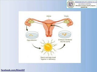 Affordable ivf in india