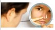 skin treatment for acne scars at home  - Clear Skin Forever