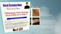 Beat Eczema By Susan Clark =Try It Risk Free Today=