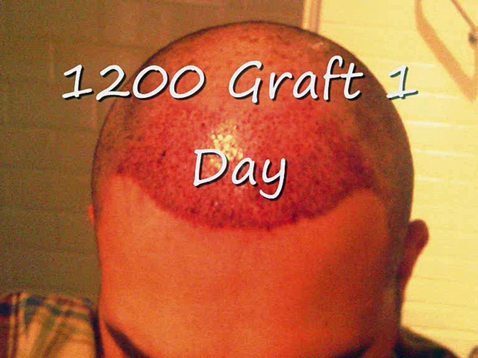 Haartransplantation by Dr Reys