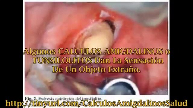 Curar Amigdalas - Enfermedades De Las Amigdalas - Calculos Amigdalinos