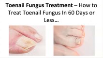 How to Treat Your Toenail Fungus With Powerful Fungal Toenail Home Remedies