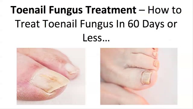 How to Treat Your Toenail Fungus With Powerful Fungal Toenail Home Remedies