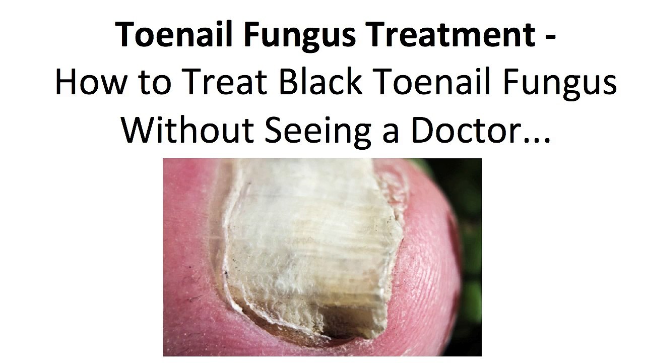 Treat Black Toenail Fungus Fool Proof Toe Fungus Treatments Doctors
