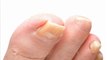 Laser Treatment For Toenail Fungus: How To Clear Nails Without Expensive Laser Removal