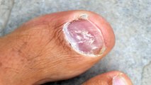 Laser Toenail Fungus Removal: Is Laser Removal Surgery Really Worth It?