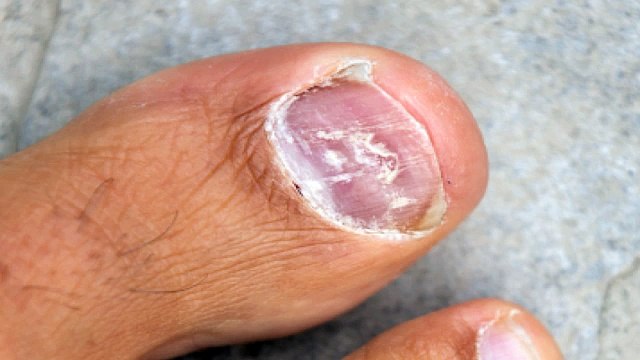 Laser Toenail Fungus Removal: Is Laser Removal Surgery Really Worth It?