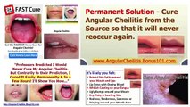 Buy Angular Cheilitis Overnight Cure you are looking for