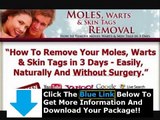 Charles Davidson Moles Warts Removal   Moles Warts And Skin Tags Removal