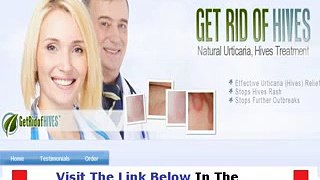 Get Rid Of Hives Reviews Bonus + Discount