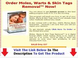 Moles Warts & Skin Tags Removal Free Download + DISCOUNT + BONUS