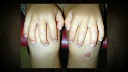 Different Types Of Warts