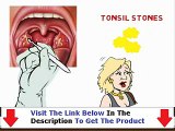 Banish Tonsil Stones FACTS REVEALED Bonus   Discount