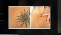 Get Rid Tattoo   Natural Tattoo Removal Solution