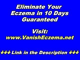 3 Killer Ways to Beat Eczema! Find How I Beat My Eczema Without Creams, Lotions Or Pills!