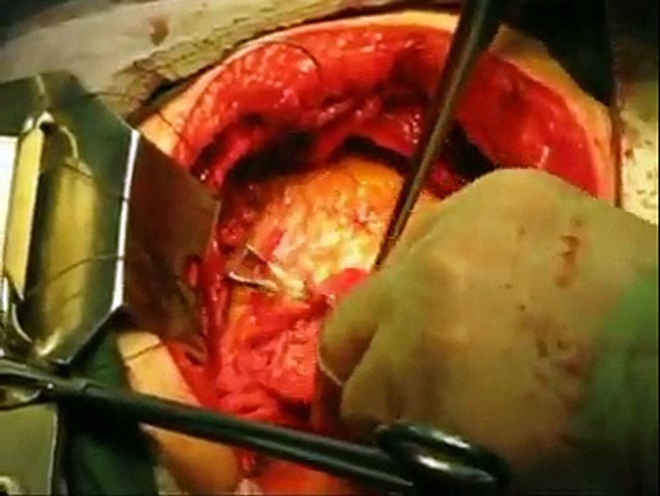 beating heart surgery v amazing