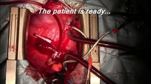 Heart Transplantation Illustrated -Extreme Surgeries (Best Video)