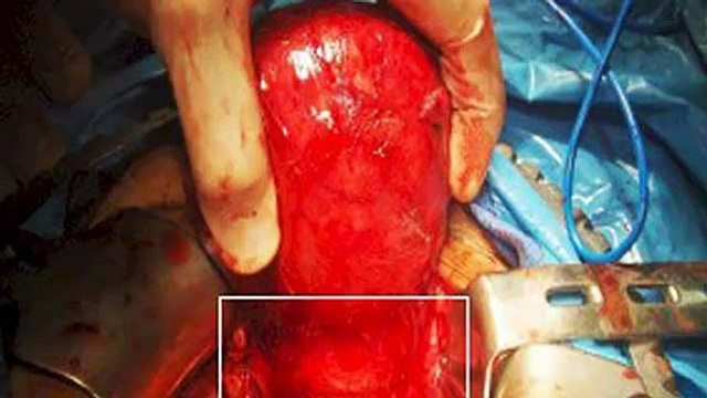 Curar Fibromas 7 Pasos Para Ser Libre de Fibromas y Curarte FIBROMAS