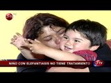 Madre desesperada busca tratamiento para su hijo que padece elefantiasis - CHV Noticias