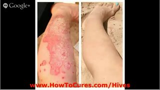 Get Rid Of Hives - Cures For Allieviating Urticaria Pigmentosa - Get Rid Of Hives