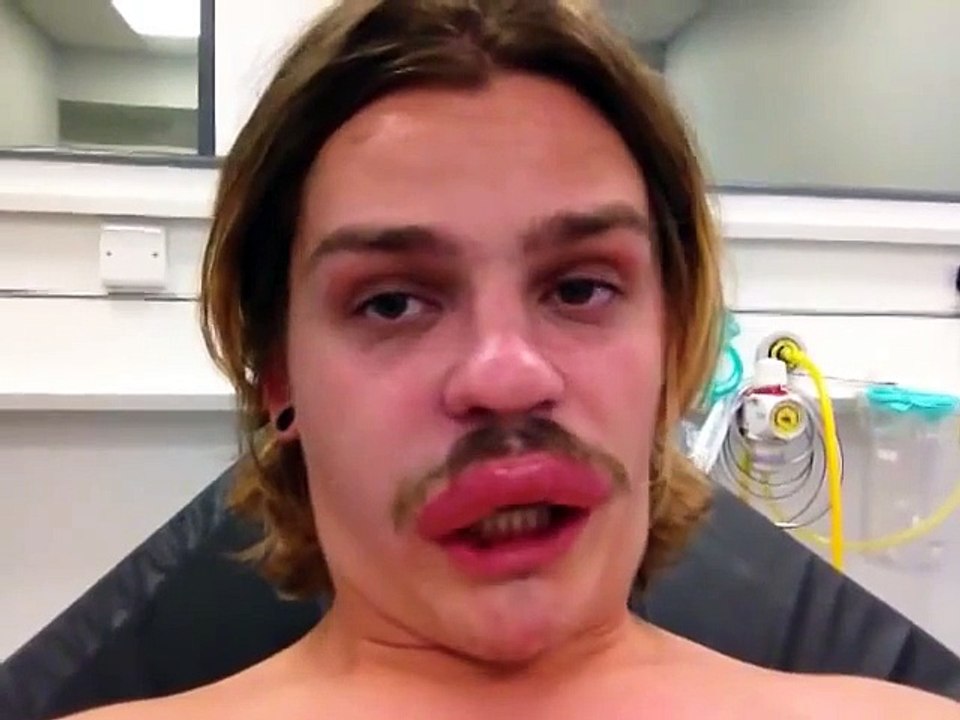 Piqûre d'insecte : mieux que le Botox sur le lèvres...