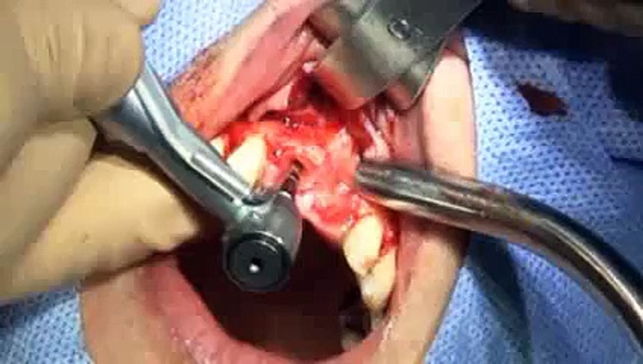 Extraction implantation immédiate en secteur antérieur